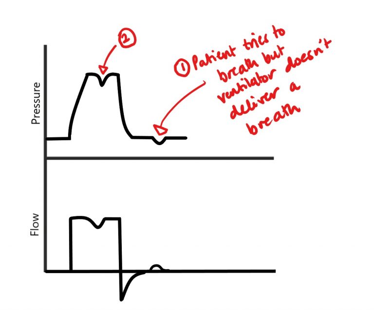 Ventilator Dyssynchrony Intensive Care in a Flash